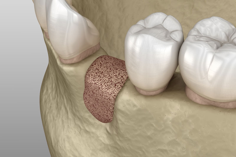 a graphic image of a lower arch of teeth, with one missing tooth that shows where a bone grafting procedure was done for a successful dental implant surgery.