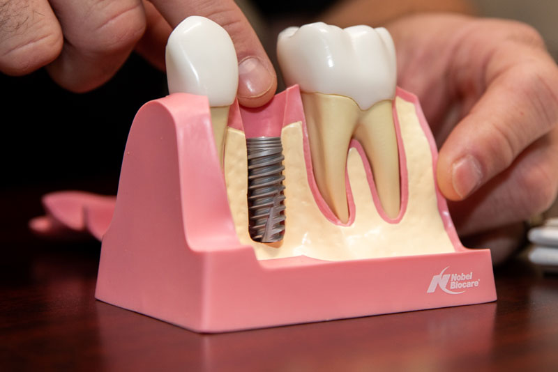 a picture of a doctors hand pointing to a dental implant post in a dental implant model to show patients how the dental implant can permanently replace their teeth.