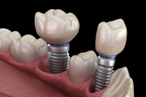 An image of multiple dental implants model with a 3D model of teeth and gums.