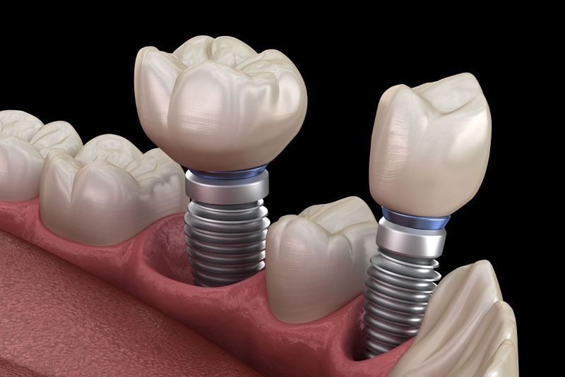 An image of multiple dental implants model with a 3D model of teeth and gums.