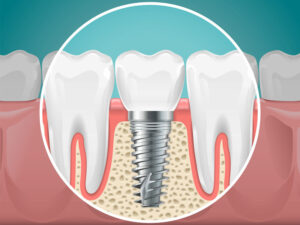 2d graphic of a single dental implant between two natural teeth.