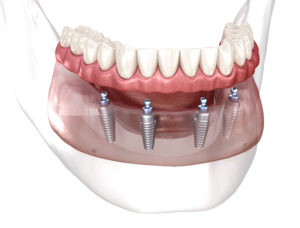 Removable mandibular prosthesis All on 4 system supported by implants. Medically accurate 3D illustration of human teeth and dentures concept.