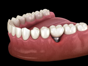 Peri-implantitis with visible gum recession. Medically accurate 3D illustration of dental implants concept.