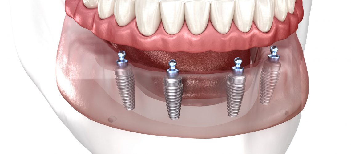 Removable mandibular prosthesis All on 4 system supported by implants. Medically accurate 3D illustration of human teeth and dentures concept.