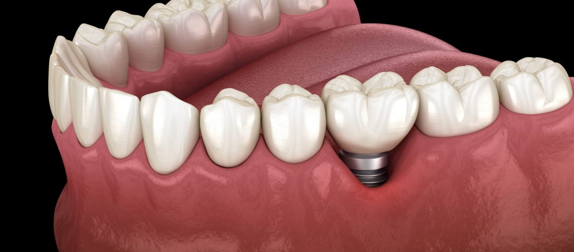 Peri-implantitis with visible gum recession. Medically accurate 3D illustration of dental implants concept.